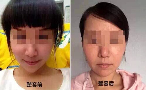 演员赴韩整容不成惨遭毁容,赴韩整容风险大!